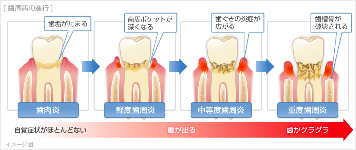 歯周病治療 | 診療科目 | 周南市久米の歯医者「ひだまり歯科医院」一日